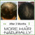 More Hair Naturally 9: Advanced Stem Cell Therapy For Thinning Hair. Helps Promote Healthier, Thicker and stronger hair growth