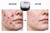 ACNNO Severe Cystic and Nodular Acne Spot Treatment. Natural - works with your own immunity to eliminate nodular and cystic acne at the source.