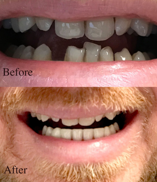 Instant Smile Professional Cosmetic Lower Teeth - New from Hand crafted detail, custom fit at home!