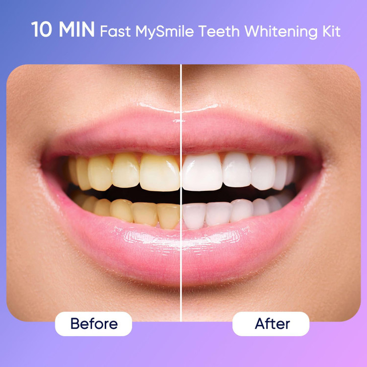 MySmile Deluxe 10 Min Teeth Whitening Kit with 28 LED Light, 35% Carbamide Peroxide Teeth Whitening Gel, Helps Remove Years of Stains from Coffee, So