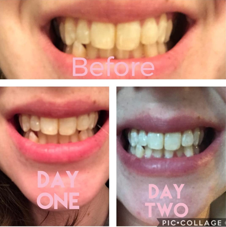 Dr Song Teeth Whitening Gel Refill 4X Syringes 35% Carbamide Peroxide