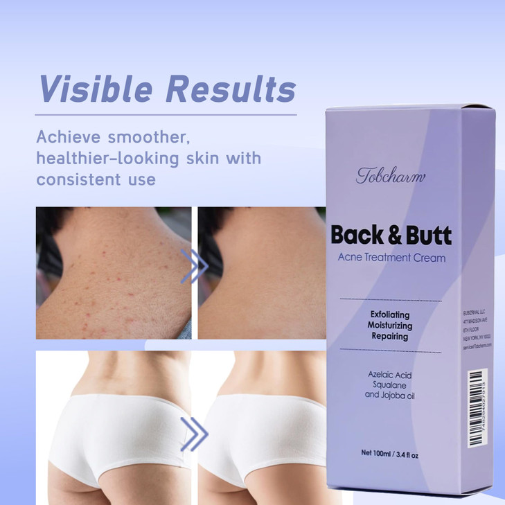 Butt Acne Clearing Treatment, Maximum Strength Body Cream for Back, Buttocks, Thigh & Chest Acne Removal, Skin Clearing Lotion for Men & Women, Foami