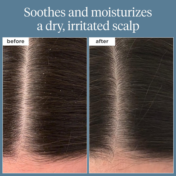 Briogeo Scalp Revival Rosemary PreWash Oil Moisturizing Scalp Treatment for Dry Flaky or Itchy Scalp Strengthens Hair So