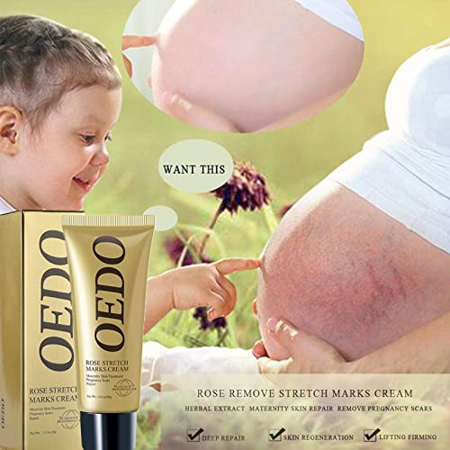 Rose Remove Stretch Marks Cream for Pregnancy Scar Removal Cream Natural Plant Essence Formula Prevention Remove Stretch
