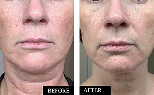 Kleem Pure Vitamin C Serum for Face for Women with Hyaluronic Acid Vitamin E Anti Aging Serum to Boost Collagen Reduce W