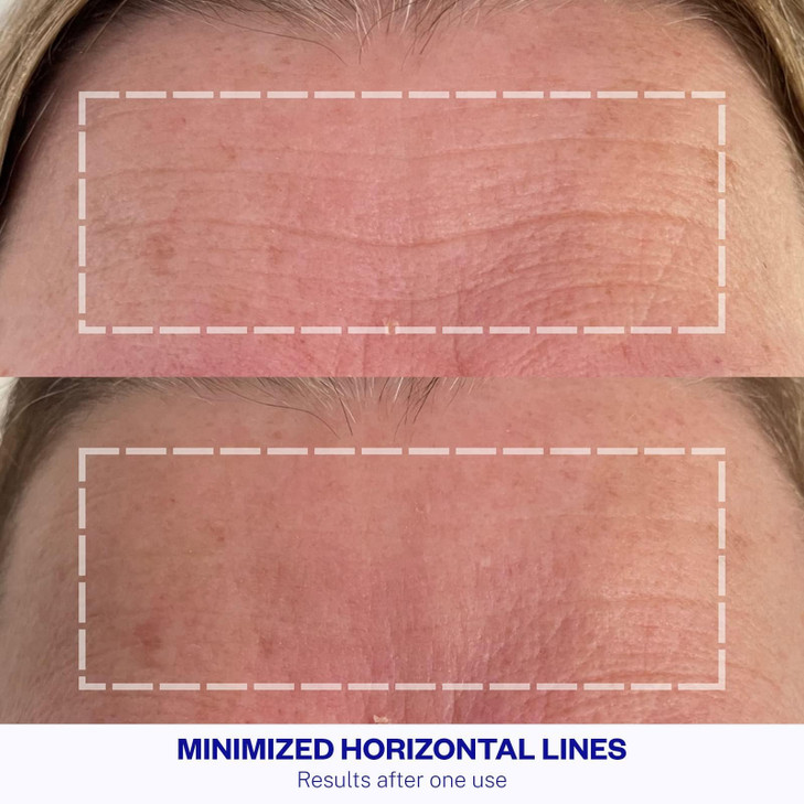 Wrinkles Schminkles Forehead Wrinkle Patches 1Pack Reusable Hypoallergenic Silicone Smoothing Pads for Reducing Frown Li