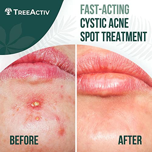 TreeActiv Cystic Acne Spot Treatment Sulfur Bentonite Clay Paste with Tea Tree 20Min or Overnight Use for Adult Hormonal