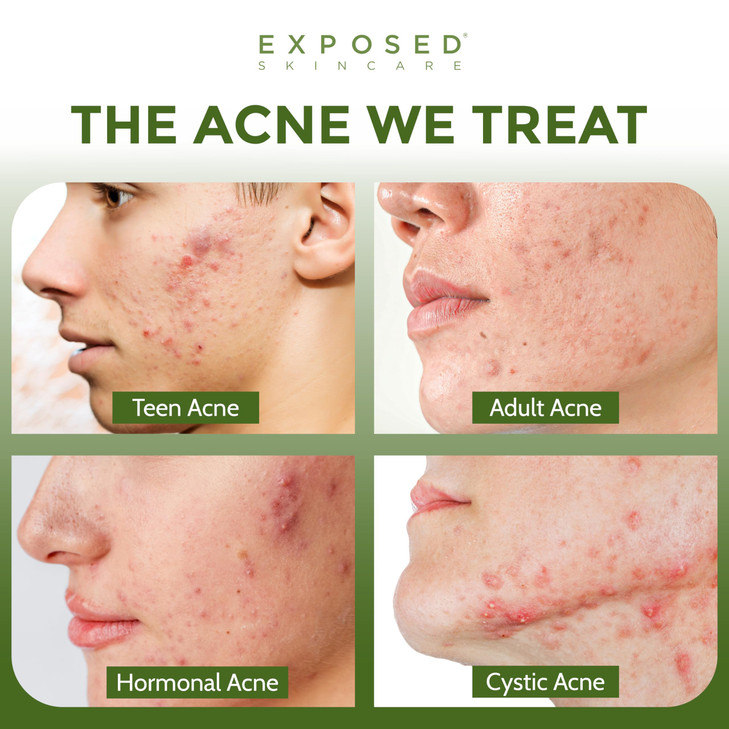 Exposed Skin Care Acne Facial Cleanser with 05 Salicylic Acid for Sensitive and AcneProne Skin Gentle Daily Face Wash fo