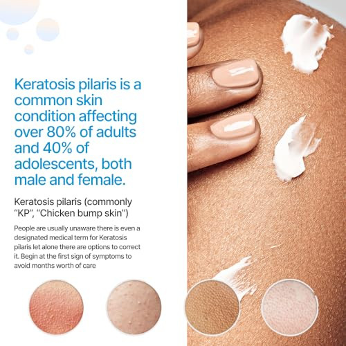 KP Essentials Keratosis Pilaris Exfoliating Body Wash Wash Away Red Bumps Caused By KP for Confident Clear Skin 6oz 1 Bo