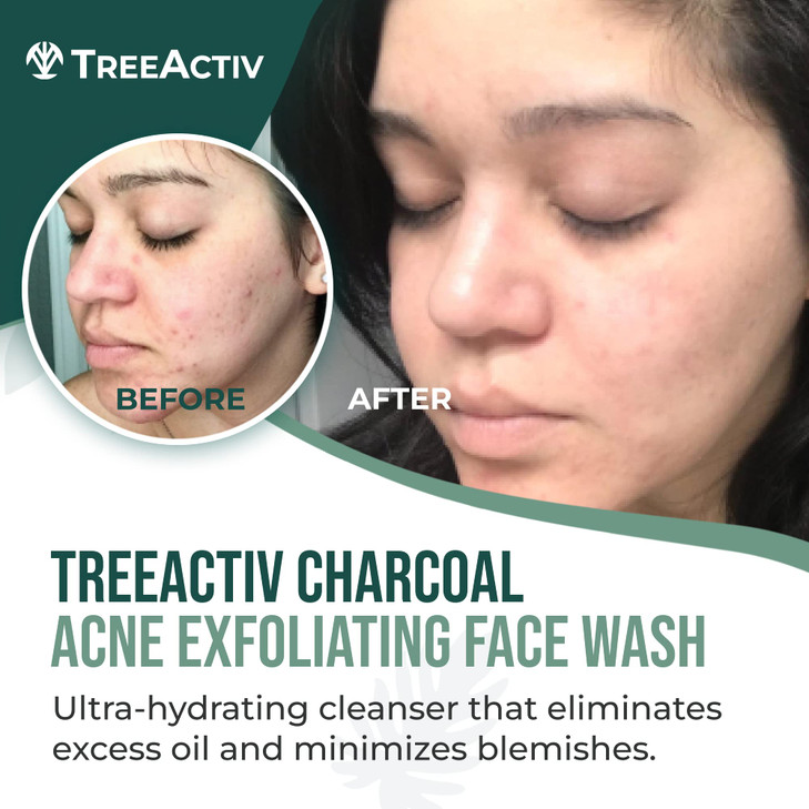 TreeActiv Acne Charcoal Face Wash 34 oz Exfoliating Daily Honey Sulfur Acne Cleanser Face Soap Deep Cleansing Moisturizi