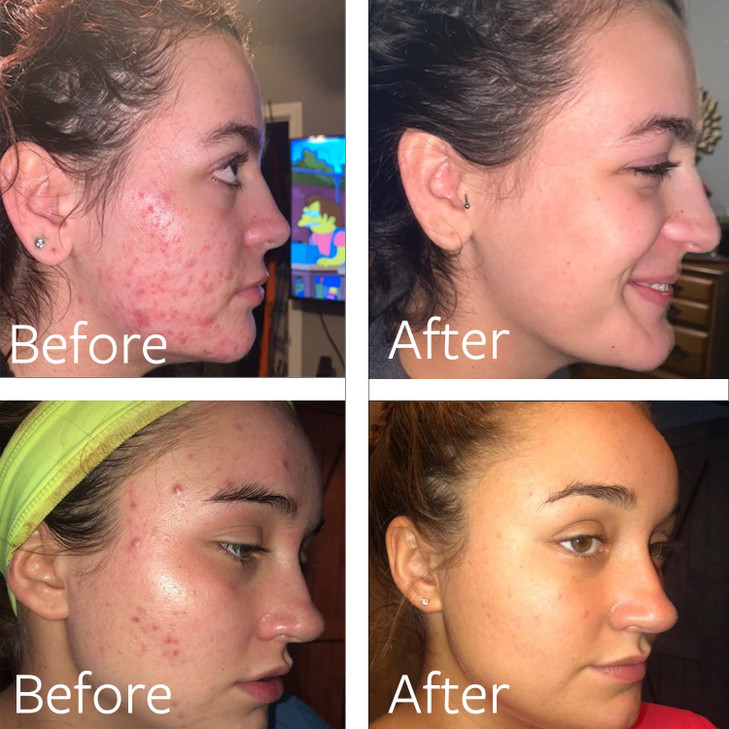 Dr Song Benzoyl Peroxide Wash 10 Acne Treatment Acne Face Wash Body Wash 8 Fl Oz Pack of 1