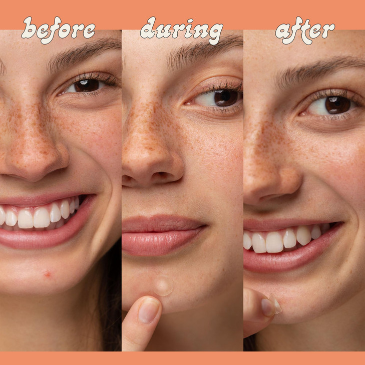 LeSpot Pimple Patches for Face Effective Invisible Hydrocolloid Acne Patches for Covering Zits Blemishes Zit Patches for