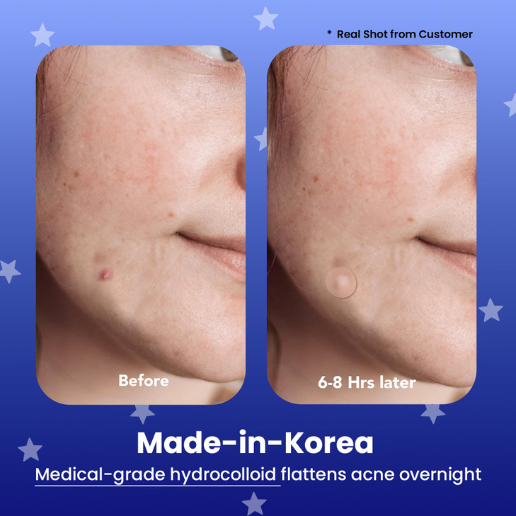 AVARELLE Spot Pimple Patches for Face Good Night Acne Cover Hydrocolloid with Tea Tree Oil Acne Spot Treatment 1214 mm 2