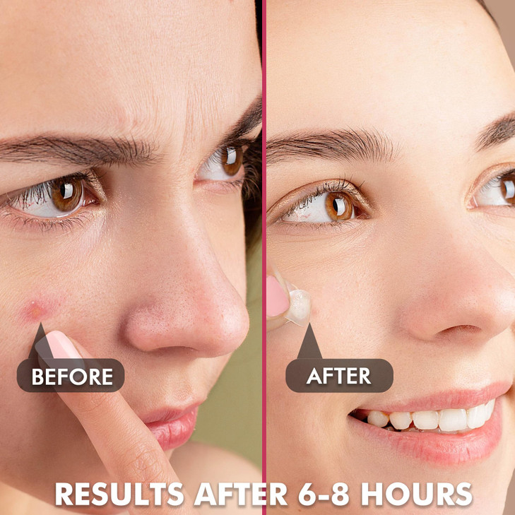 Albatross Health New England Invisible Pimple Patches for face plain Hydrocolloid Acne Patches HSA FSA eligible Spot Dot