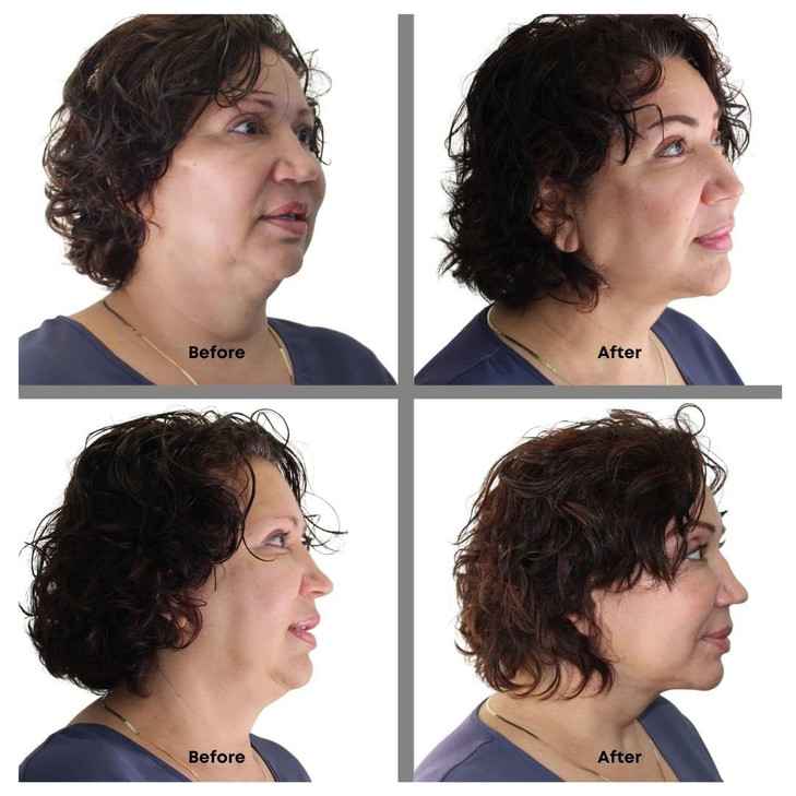 Bring It Up Instant Neck Lift Tape 30 Day Supply Transparent Neck Lifting Anti Wrinkle Stickers Tones Sagging Necklines