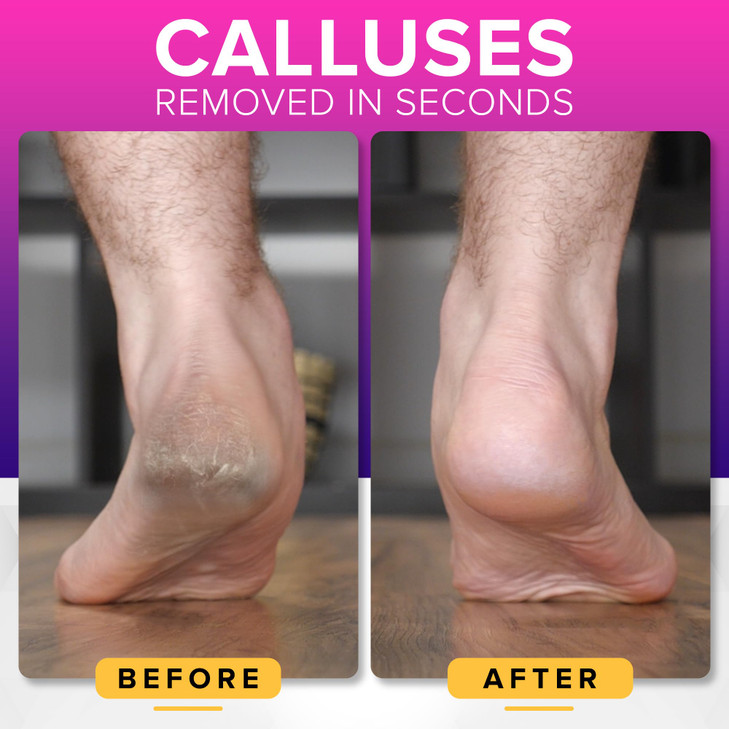 RUSTPROOF Foot File Callus Remover for Feet with Skin Catcher XL Size NYK1 MEGAFILE Foot Callus Remover for Wet Dry Use
