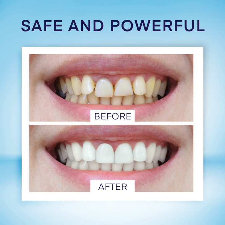 AsaVea Smile Teeth Whitening Pen 4 Pens for Teeth Whitening 40 Uses Effective Painless No Sensitivity TravelFriendly Bea