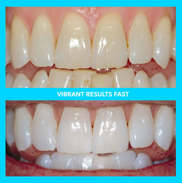 Vibe Teeth Whitening Pens Healthy Peroxide Free 4 Pack NonToxic Fast Results 3ml per pen Vegan Painless teeth whitening