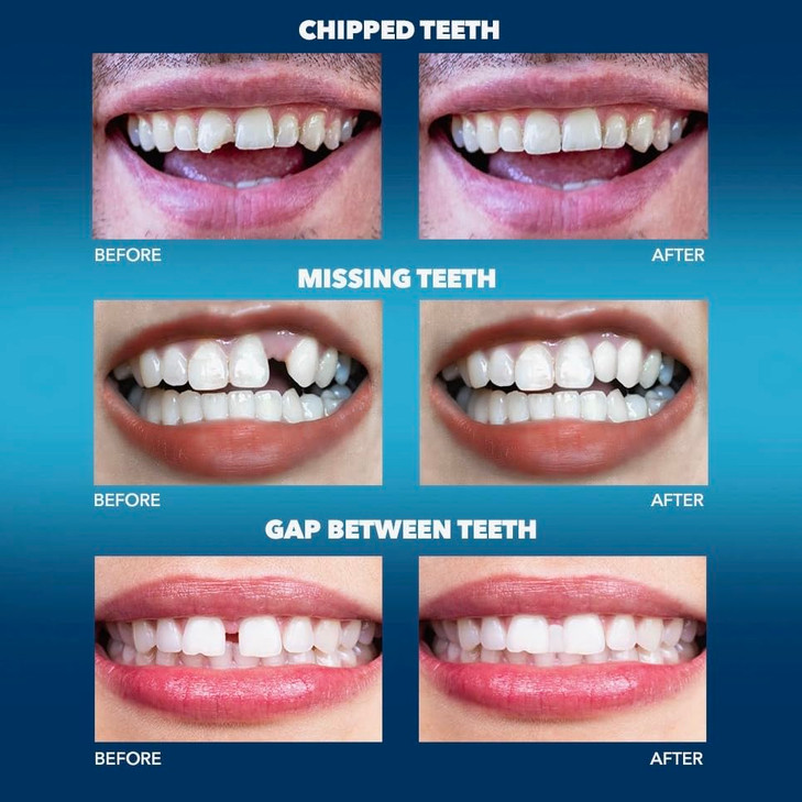 Imako Tooth Tinted Plastic Natural Color Temporary Tooth Made in USA
