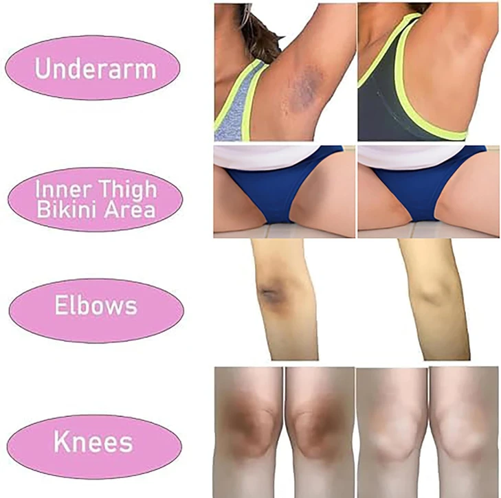 Skin Whitening Cream Bleaching Cream for Body Intimate Area Private Parts Underarm Knees Elbows Inner Thigh Bikini