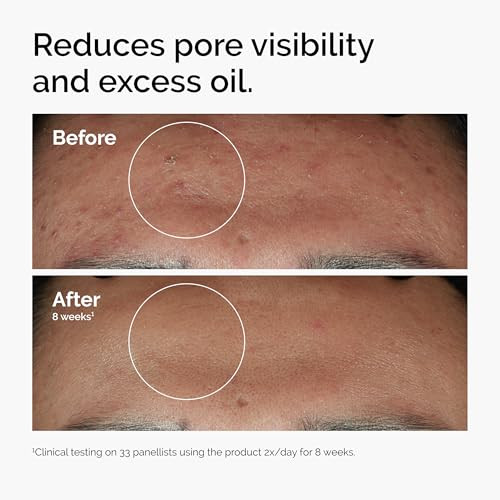 The Ordinary Niacinamide 10 + Zinc 1, Smoothing Serum for Blemish-Prone Skin, 1 Fl Oz