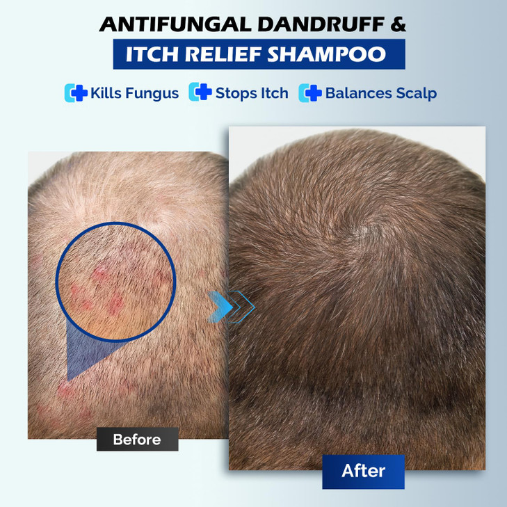 oely Antifungal Shampoo for Seborrheic Dermatitis, Folliculitis - Fresh