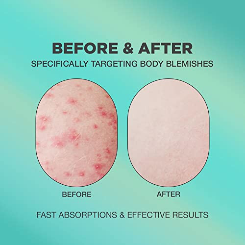 Butt Acne Cream | Buttocks Acne Lotion for Body Blemishes | Body Acne Cream Formulated with Natural Formula | Butt