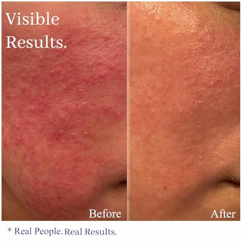 Hey Honey Skincare Relax Instant Rosacea Relief Cream For Sensitive Skin Calming Face Moisturizer For Facial Redness And Irritation