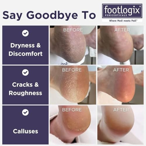 Footlogix Double Sided Stainless Steel Foot File With Rubberized Handle Coarse And Fine Grit Foot Exfoliator For Dry Rough Skin Professional
