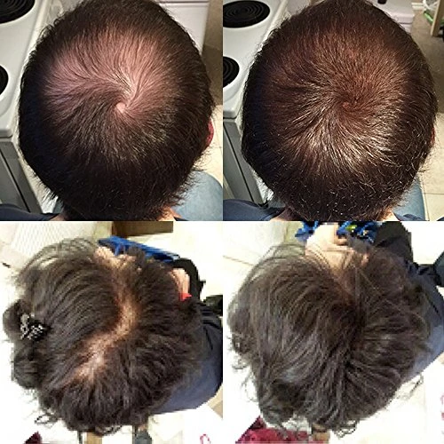 Nor1 Keratin Hair Building Fibers Natural Instant Hair Filler And Thickener For Men And Women Completely Cover Up And Conceal Thinning Areas