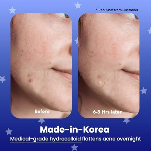 Avarelle Spot Pimple Patches For Face Good Night Acne Cover Hydrocolloid With Tea Tree Oil Acne Spot Treatment 12 14 Mm 24 Ct