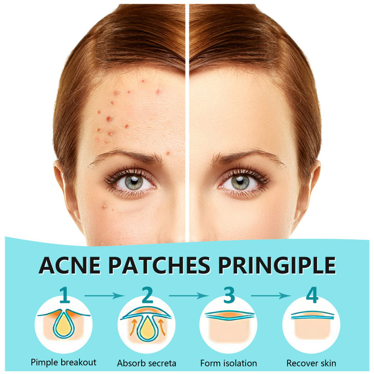 Piccircuit 180 Counts Pimple Patches For Face Hydrocolloid Acne Patches For Face Invisible Zit Patches For Face Pimple Patch Acne Spot