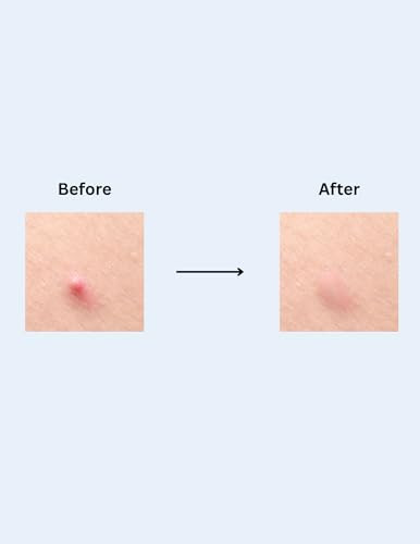 Acnemed Hydrocolloid Acne Pimple Patches Invisible Spot Treatment For Face Overnight Healing Blemish Cover Waterproof 36 Count