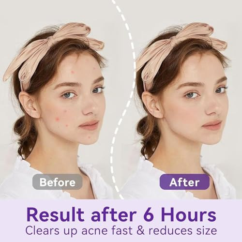 Omadoto Salicylic Acid Acne Patches Overnight Spot Treatment With Bha Absorbs And Helps Unclog 2 Sizes 10Mm And 12Mm 72 Count Easy Peel