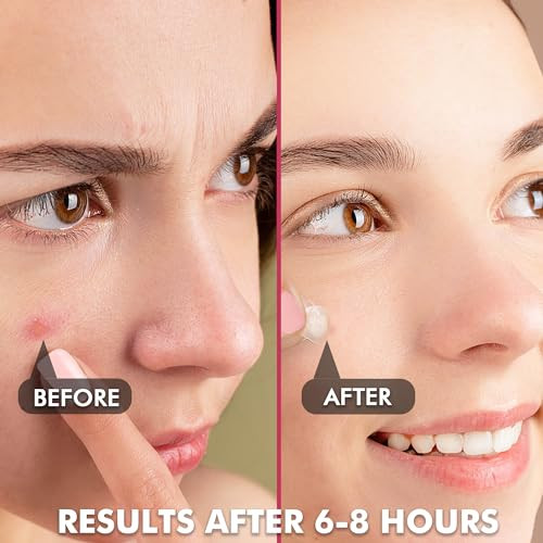 Invisible Pimple Patches Acne Patches For Face 2 Size 180 Counts
