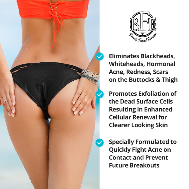 Anti-Acne Buttocks & Thigh Treatment- Clears Away Acne, Pimples, Zits, Dark Spots & Ingrown Hairs on the Buttocks &Thigh Area. Prevents Future Breako