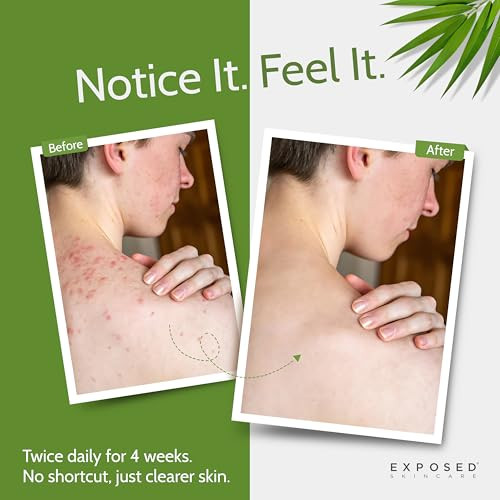 Exposed Skin Care, Body Acne Wash with Salicylic Acid, Glycolic Acid and Tea Tree Oil  Tri-Powered Gentle Exfoliating Cleanser for Back, Chest and B