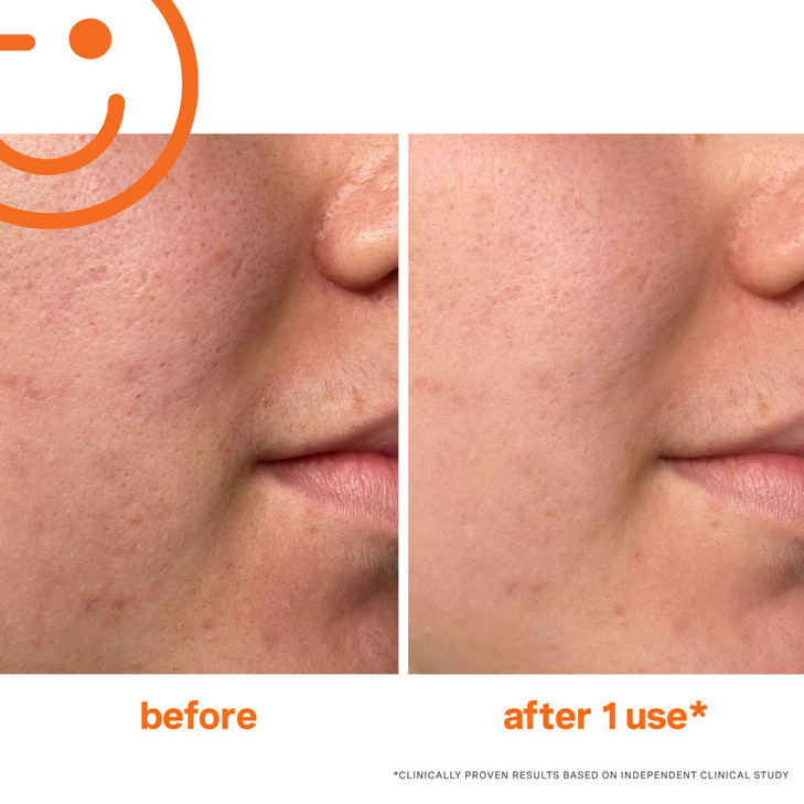 Kate Somerville ExfoliKate Intensive Exfoliating Treatment  Salicylic Acid and Lactic Acid Super Facial Scrub Improves Texture and Pores, 2 Fl Oz