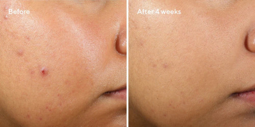 Murad Clarifying Water Gel 2 oz- clearer skin after 4 weeks