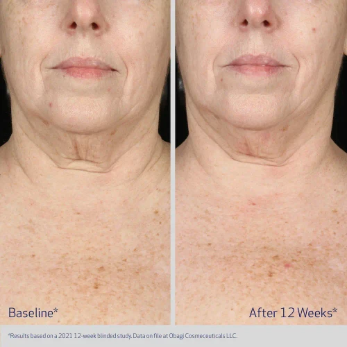 Obagi ELASTIderm Neck and Decollete Concentrate 2 fl oz before and after 2
