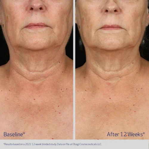 Obagi ELASTIderm Neck and Decollete Concentrate 2 fl oz before and after 1