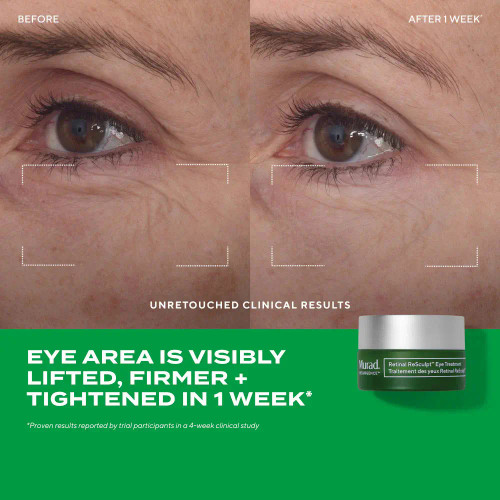 Murad Retinal ReSculpt Eye Lift Treatment 0.5 oz- before and after