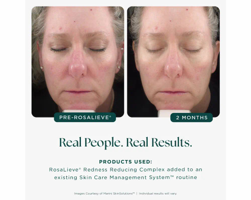 Jan Marini RosaLieve Redness Reducing Complex | Skin Elite