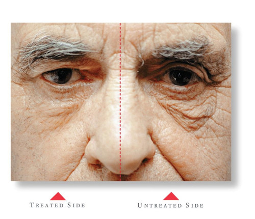 Cellex-C Advanced-C series results