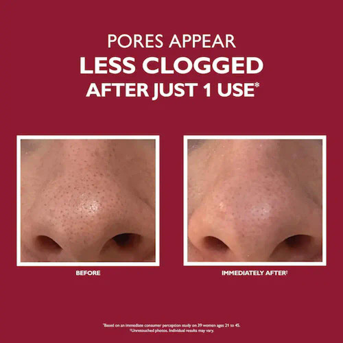 Peter Thomas Roth Even Smoother Microdermabrasion Exfoliating Pore Purifier  1.7 fl oz _before and after