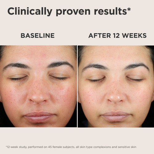 EltaMD UV Skin Recovery Sunscreen Before and After Showing Reduced Redness