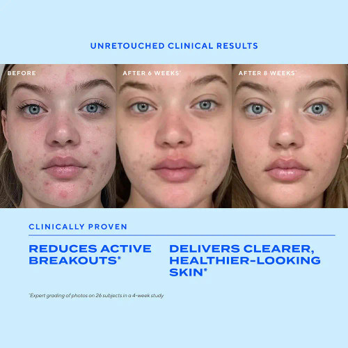 Murad Biome-Balancing Clear & Prevent Acne Serum 1 fl oz- before and after