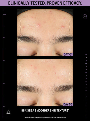 Allies of Ski6 Azelaic & Kojic Advanced Clarifying Serum 1 fl oz - SkinElite - before & after 1