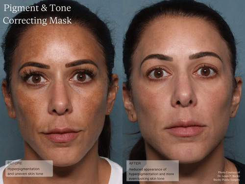 Senté Pigment & Tone Correcting Mask 1.7 fl oz - SkinElite - before and after 1