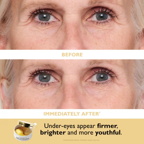 Peter Thomas Roth Patch + Go Eye Patch Travel Pack - before and after 2